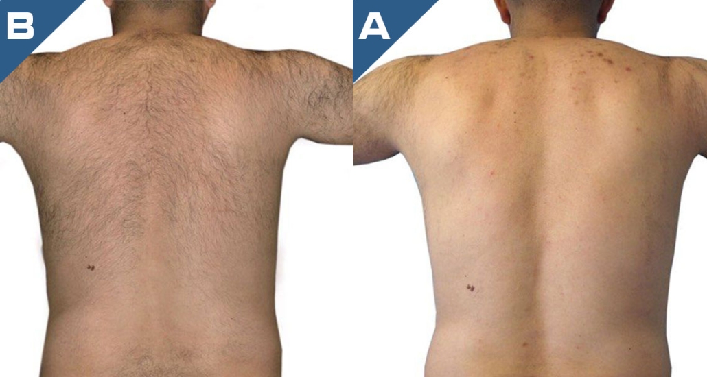 beautology-laser-systems-eplileve-hair-removal-1