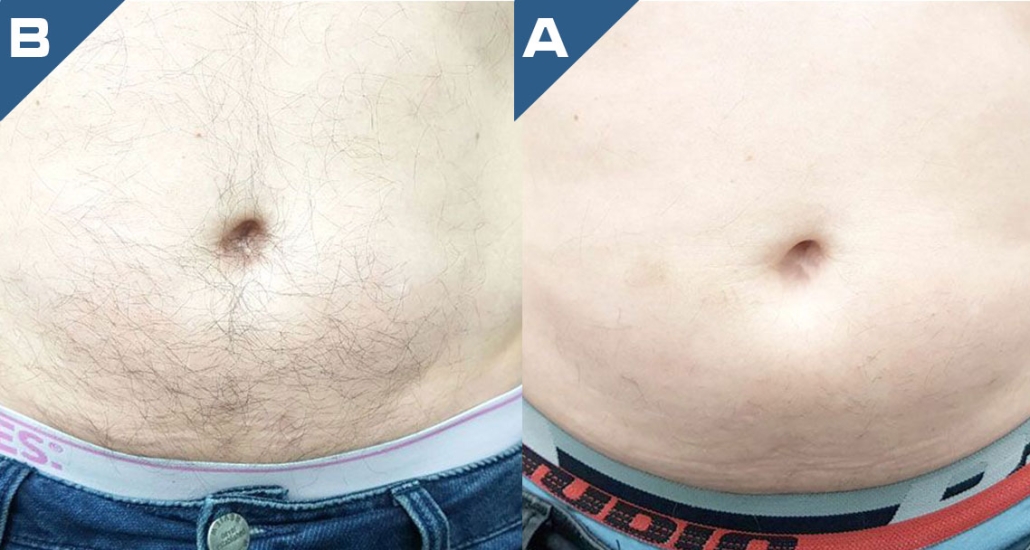 beautology-laser-systems-eplileve-hair-removal-2