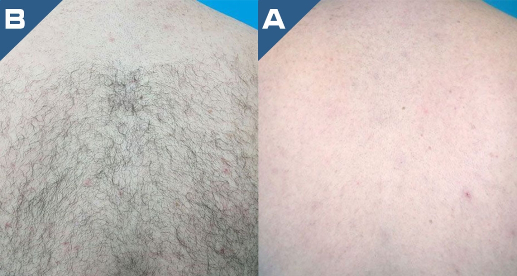 beautology-laser-systems-eplileve-hair-removal-3