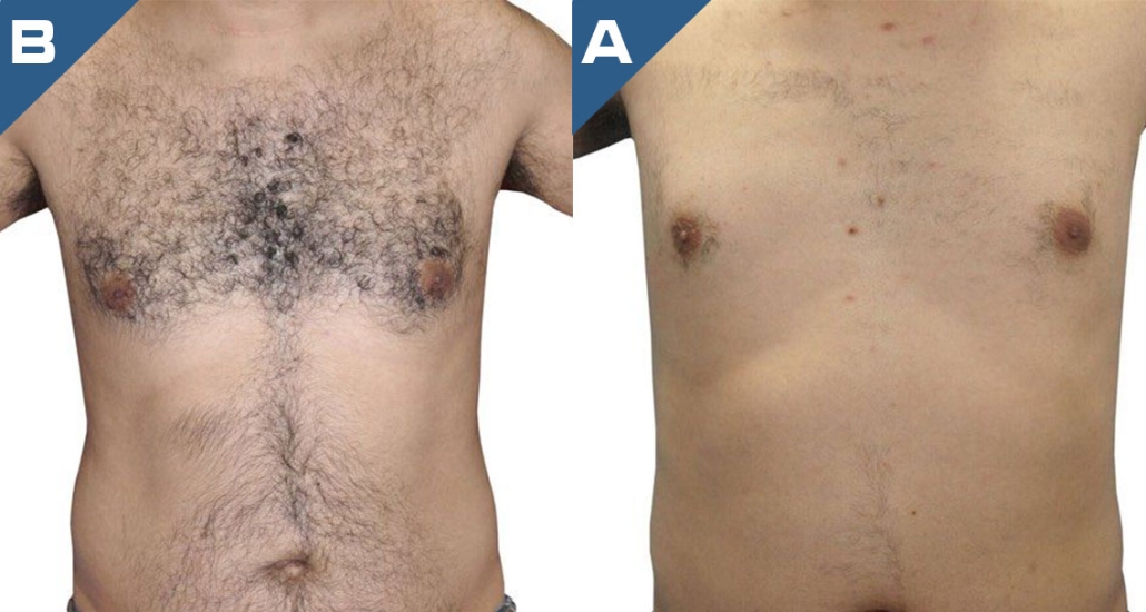 beautology-laser-systems-eplileve-hair-removal-4