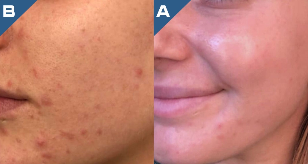 beautology-laser-systems-versa-pro-acne-treatment