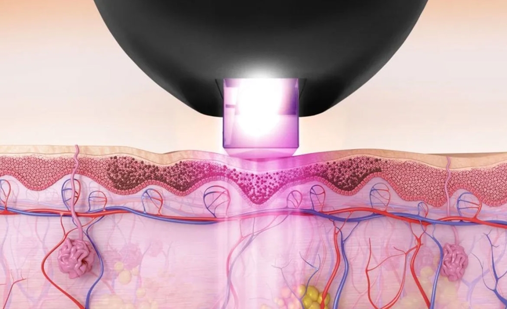 beautology-laser-systems-versa-pro-photo-rejuvenation