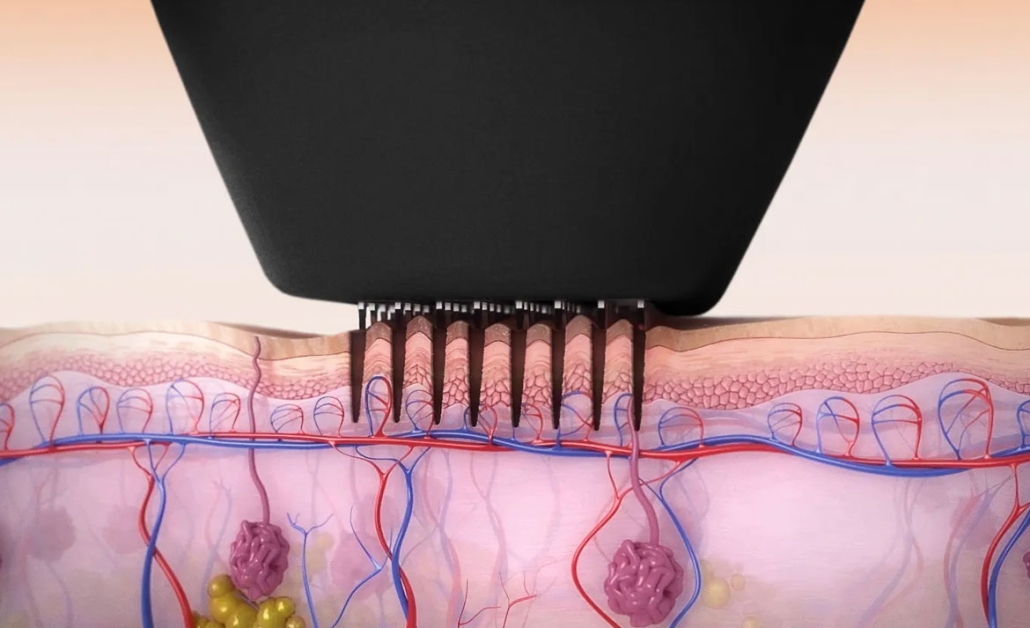 beautology-laser-systems-versa-pro-skin-resurfacing