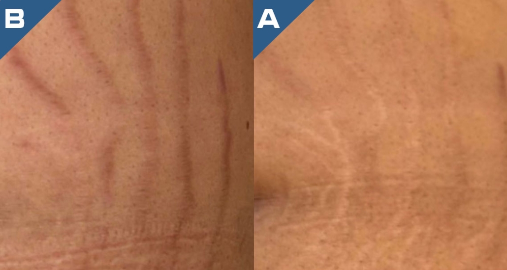 beautology-laser-systems-versa-pro-skin-resurfacing-treatment