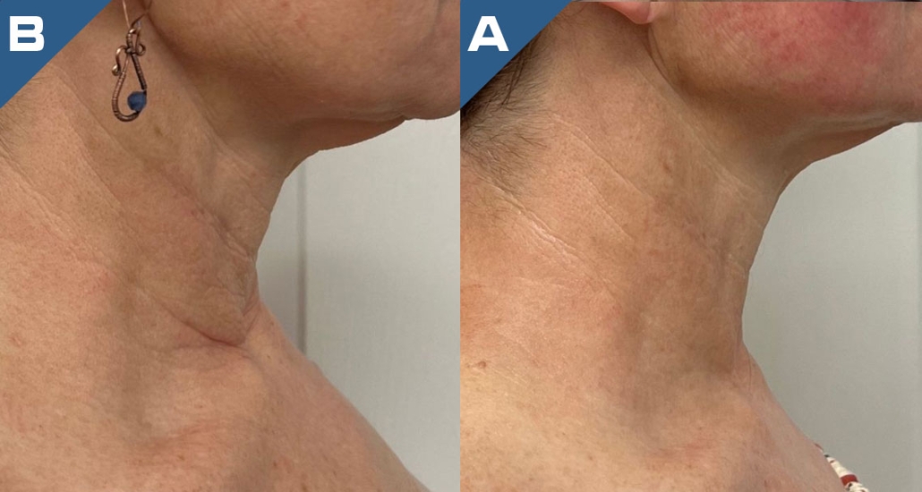 beautology-laser-systems-versa-pro-skin-resurfacing-treatment-2