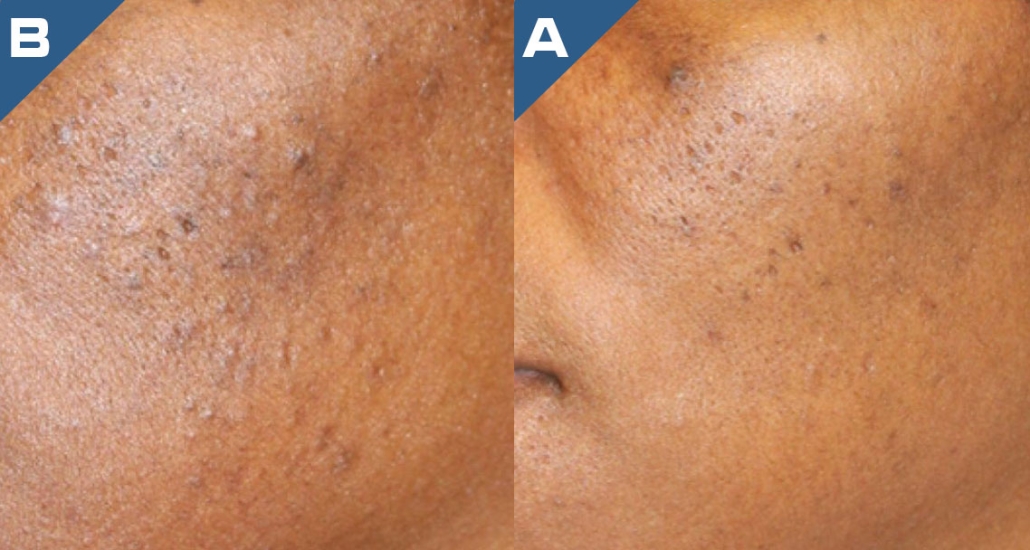 beautology-laser-systems-versa-pro-skin-resurfacing-treatment-3