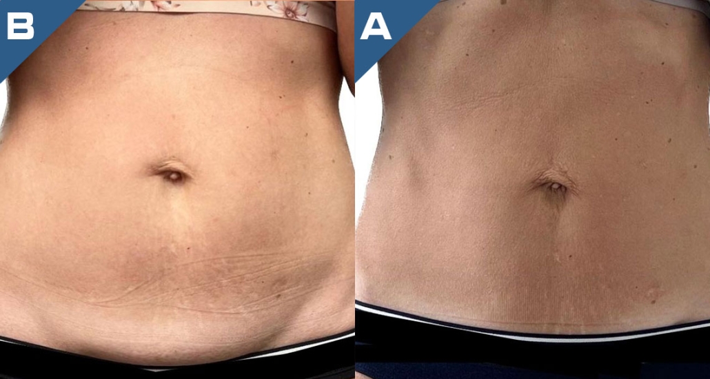 beautology-laser-systems-versa-pro-skin-tightening-treatment