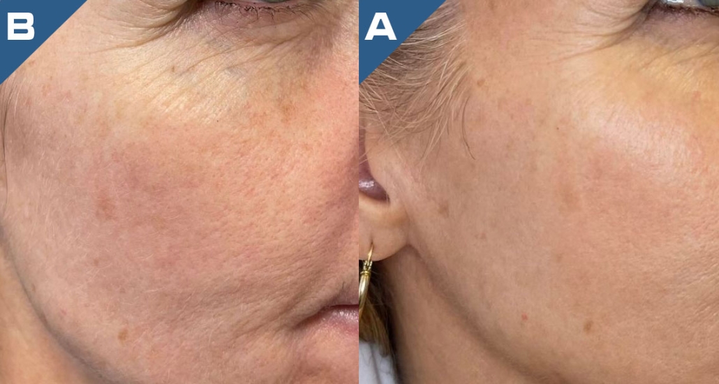 beautology-laser-systems-versa-pro-tribella-treatment