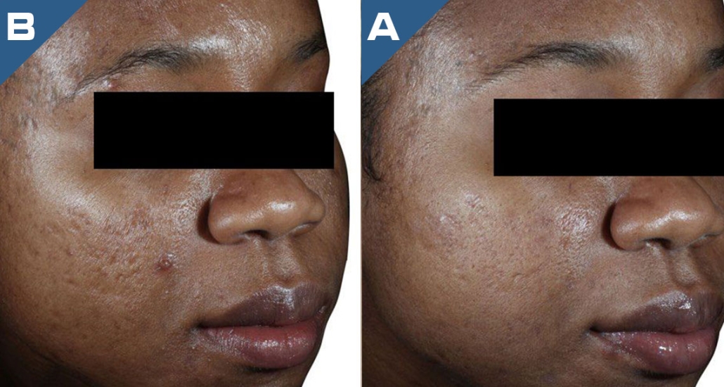 beautology-laser-systems-viva-md-acne-scar-reduction