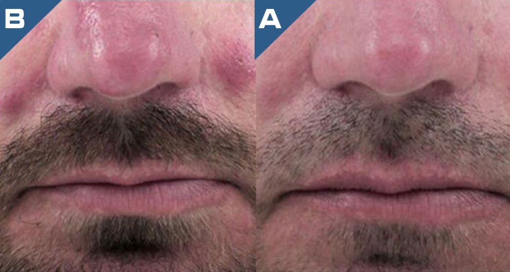 beautology-laser-systems-viva-md-rosacea-reduction