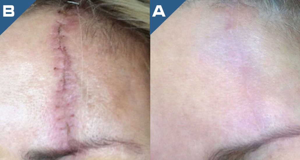 beautology-laser-systems-viva-md-scar-reduction
