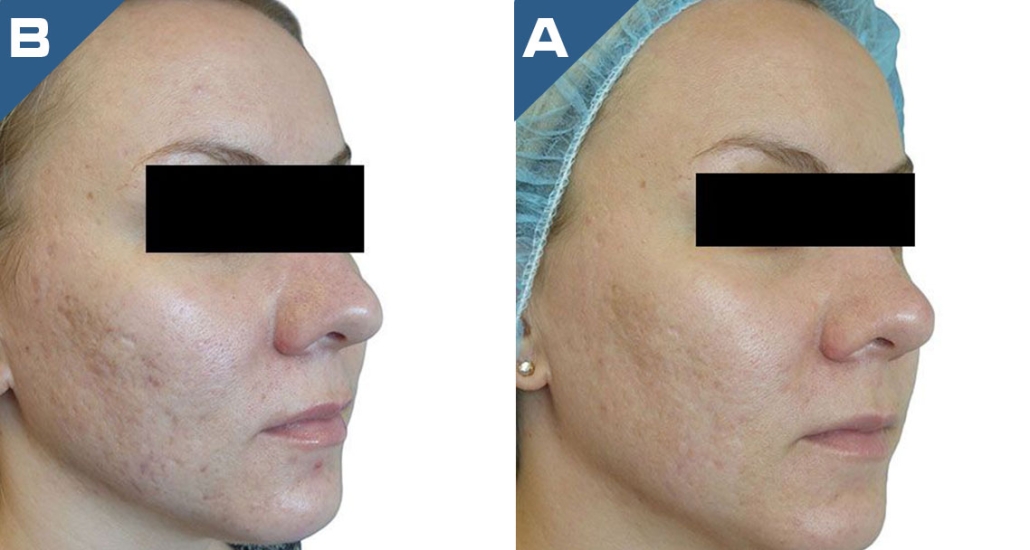 beautology-laser-systems-viva-md-skin-resurfacing