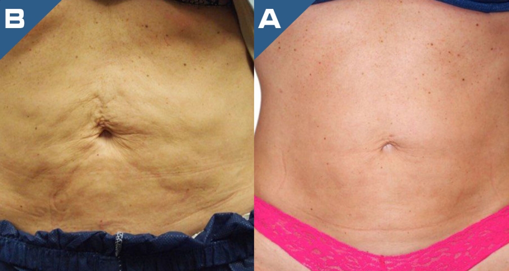 beautology-laser-systems-viva-md-skin-tightening