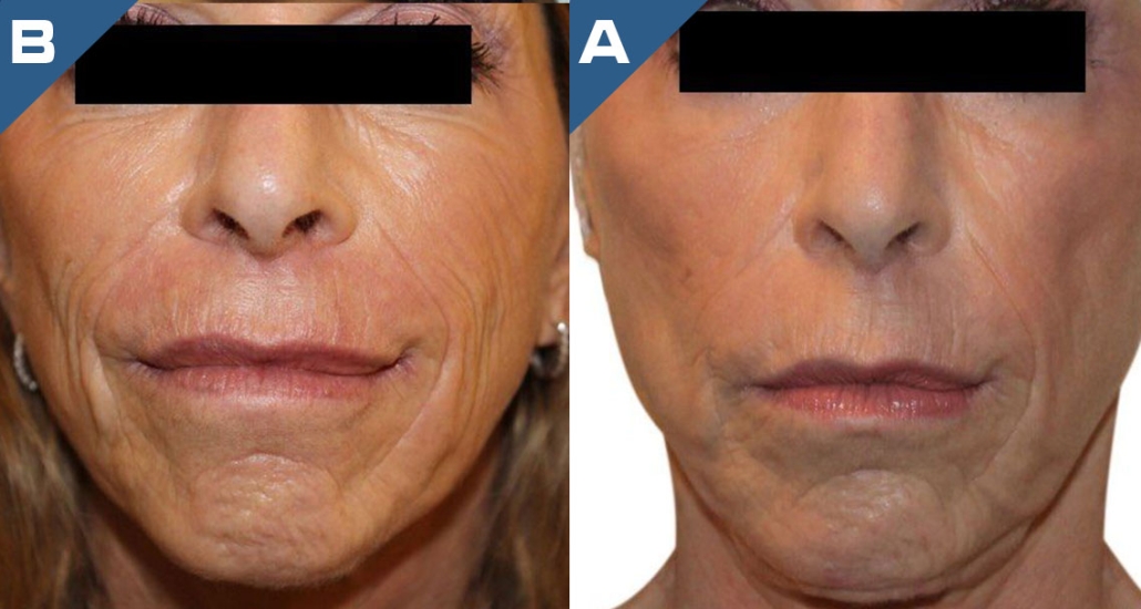 beautology-laser-systems-viva-md-wrinkle-reduction